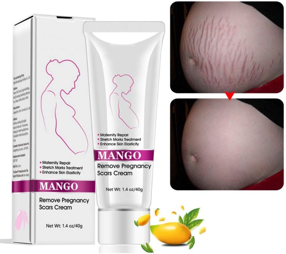 NALACAL Mango Stretch Marks and Scar Cream Stretch Marks Scar