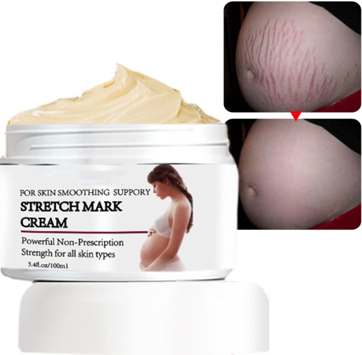 KASTWAVE Stretch Marks and Scar Cream, Stretch Marks and Scar Removal Cream for Pregnancy, Stretch Marks Scar Belly Creams for Wrinkles, Obesity Fat Stretch Mark Moisturizing, Remove Marks (100ml)